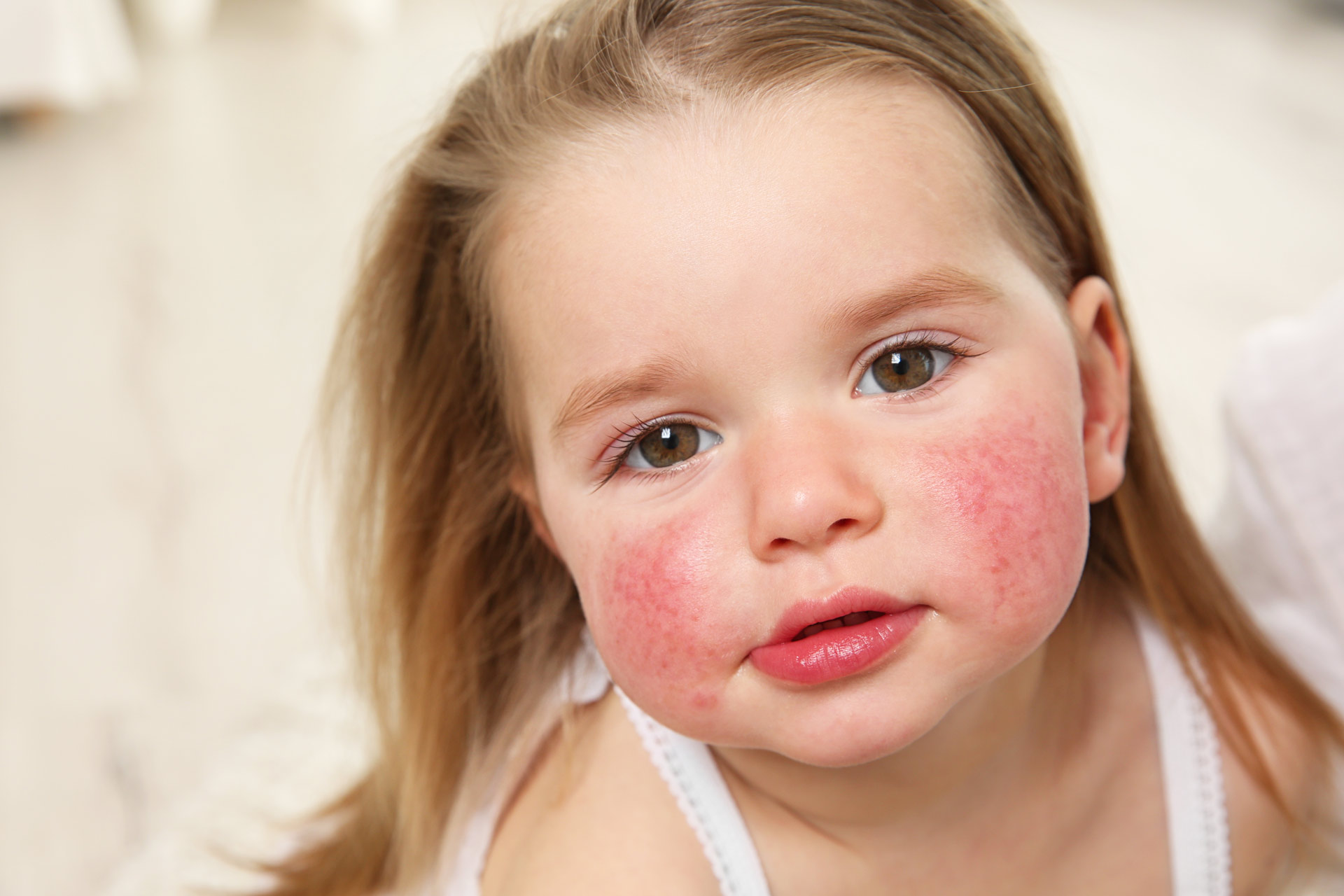 rimedi naturali allergia bambini