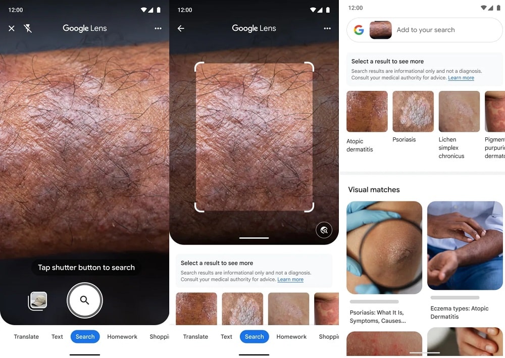 Google Lens malattie della pelle min